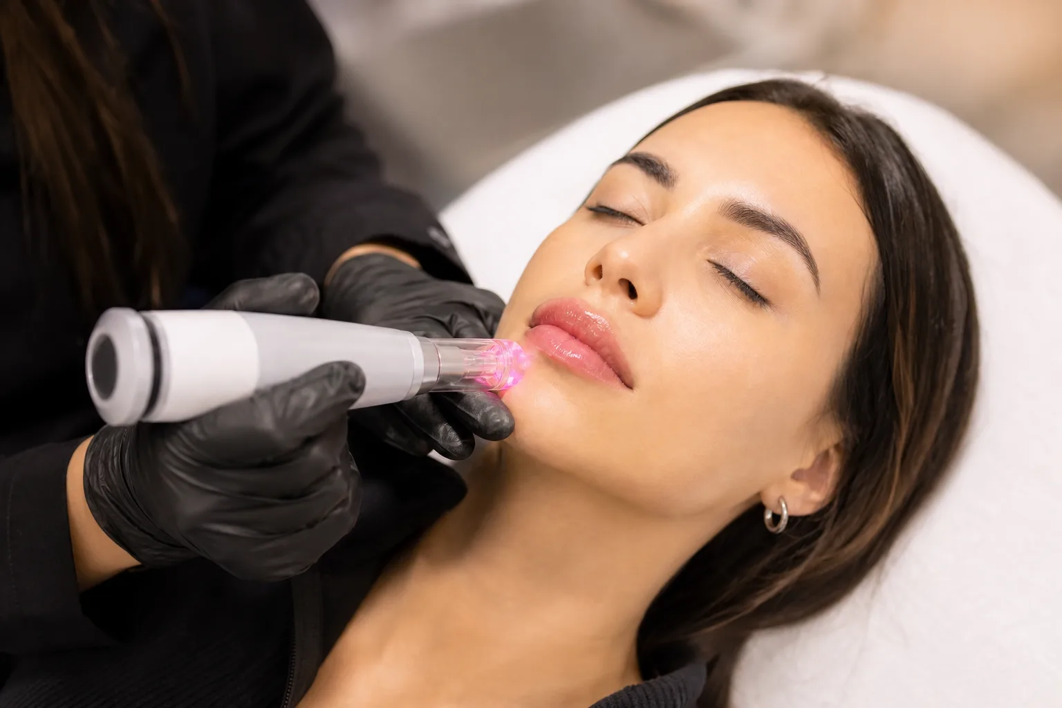Laser de Volumização Labial + Hidragloss — tratamento e cuidados
